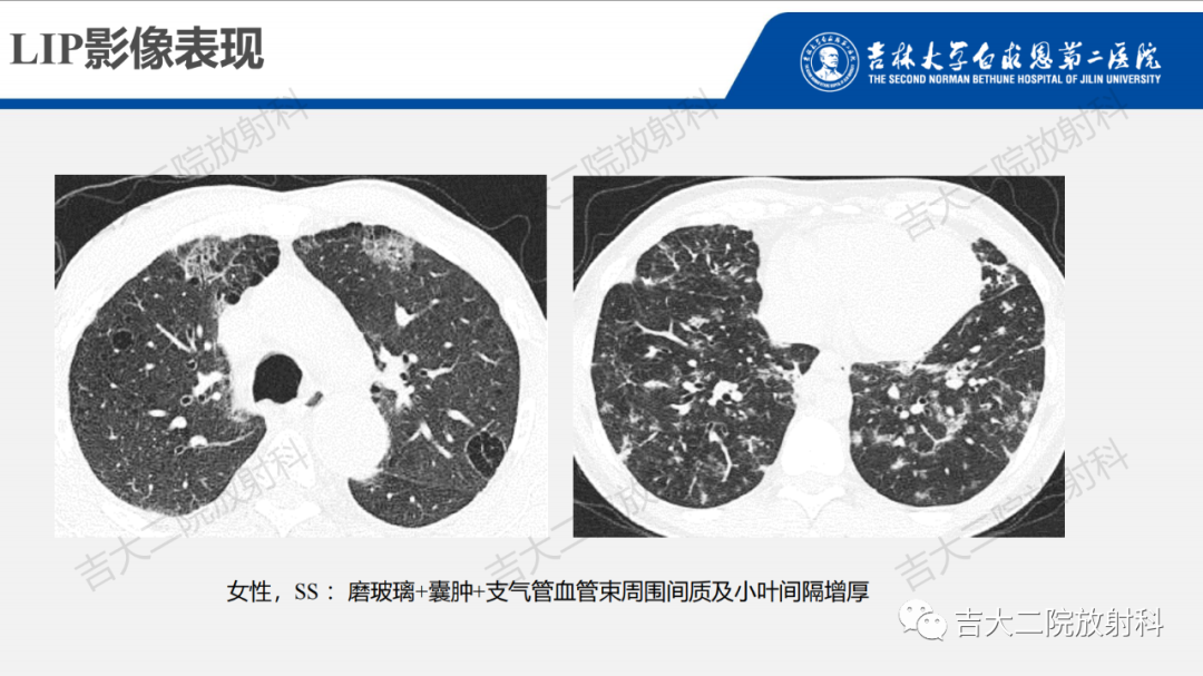 影像PPT - 【PPT】肺含气囊性病变的影像表现-51