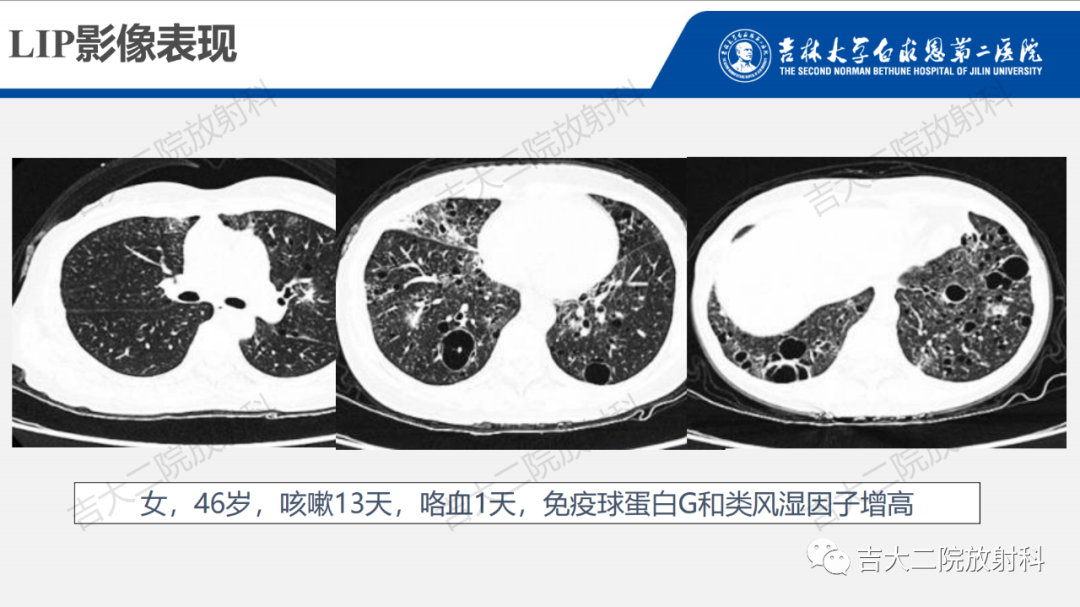 影像PPT - 【PPT】肺含气囊性病变的影像表现-52