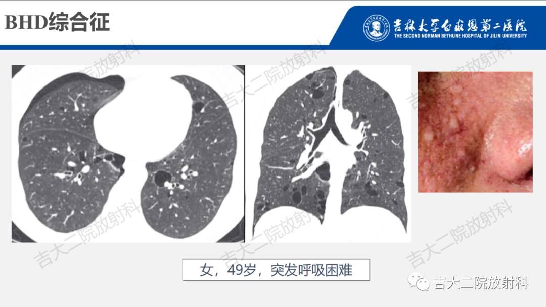 影像PPT - 【PPT】肺含气囊性病变的影像表现-56