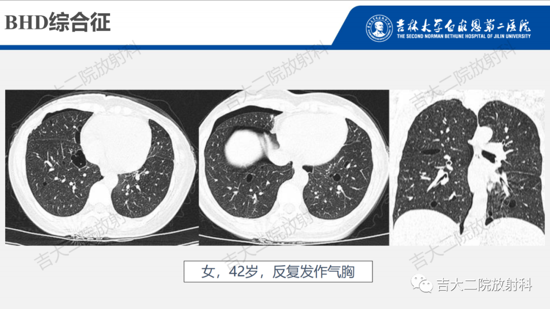 影像PPT - 【PPT】肺含气囊性病变的影像表现-58