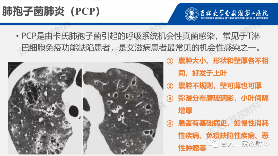 影像PPT - 【PPT】肺含气囊性病变的影像表现-59