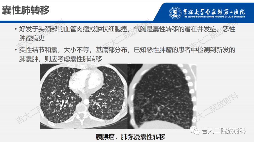影像PPT - 【PPT】肺含气囊性病变的影像表现-61