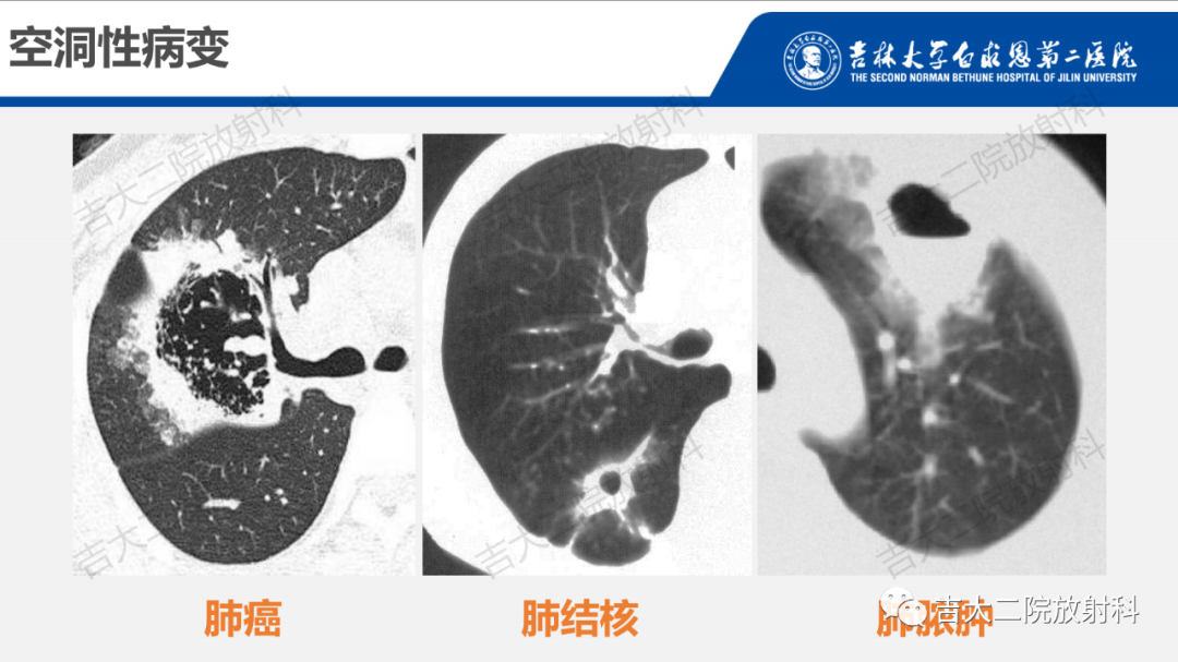 影像PPT - 【PPT】肺含气囊性病变的影像表现-65