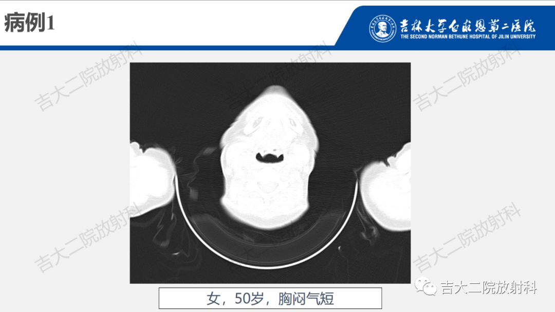影像PPT - 【PPT】肺含气囊性病变的影像表现-68