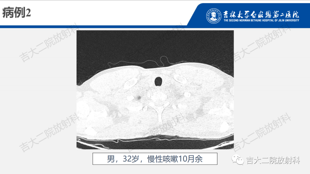 影像PPT - 【PPT】肺含气囊性病变的影像表现-70