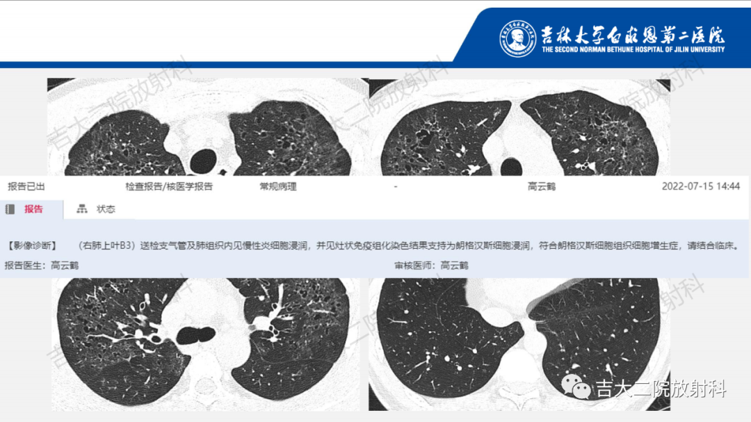 影像PPT - 【PPT】肺含气囊性病变的影像表现-71