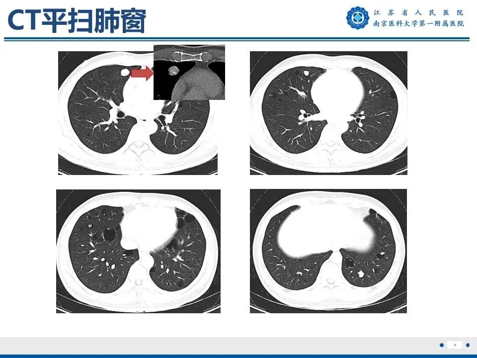 影像PPT - 【PPT】胸腺黏膜相关组织淋巴瘤-3