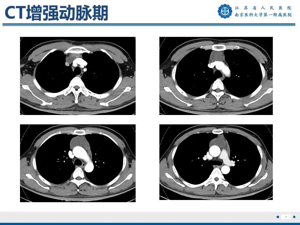 影像PPT - 【PPT】胸腺黏膜相关组织淋巴瘤-4