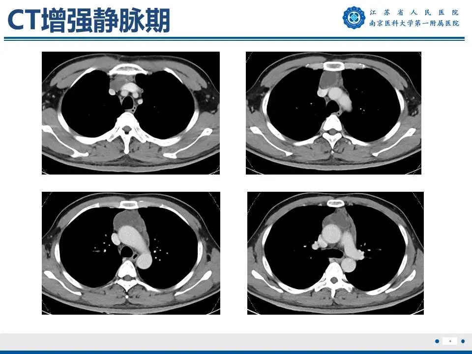 影像PPT - 【PPT】胸腺黏膜相关组织淋巴瘤-5