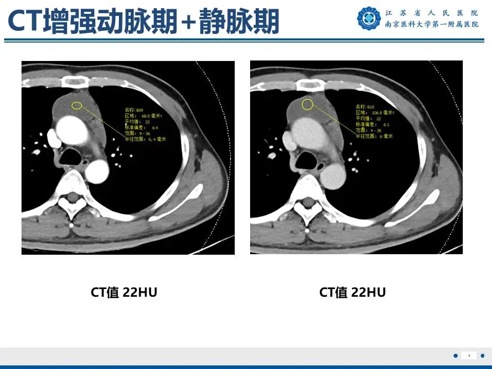 影像PPT - 【PPT】胸腺黏膜相关组织淋巴瘤-6
