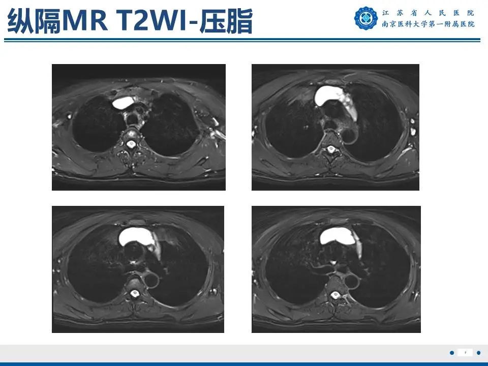 影像PPT - 【PPT】胸腺黏膜相关组织淋巴瘤-8