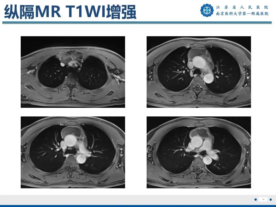影像PPT - 【PPT】胸腺黏膜相关组织淋巴瘤-12