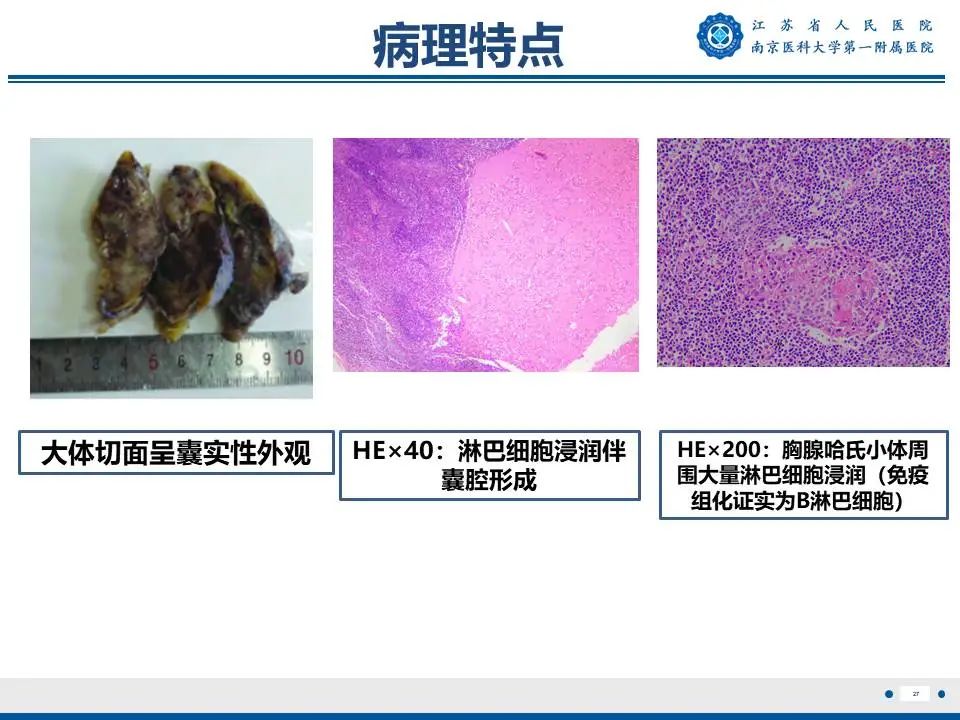 影像PPT - 【PPT】胸腺黏膜相关组织淋巴瘤-28