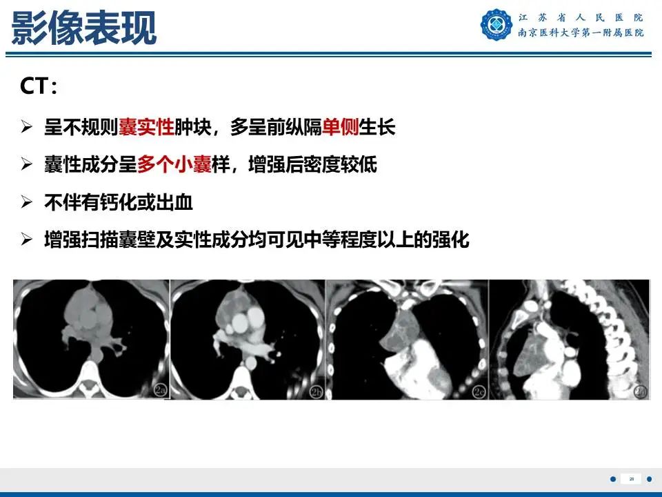影像PPT - 【PPT】胸腺黏膜相关组织淋巴瘤-29