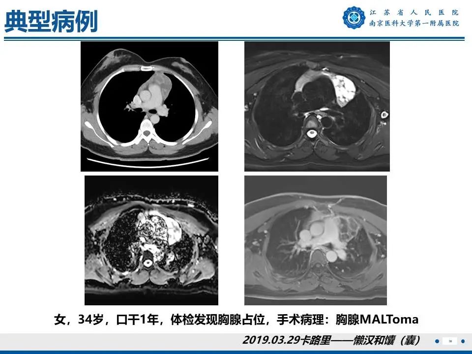 影像PPT - 【PPT】胸腺黏膜相关组织淋巴瘤-31