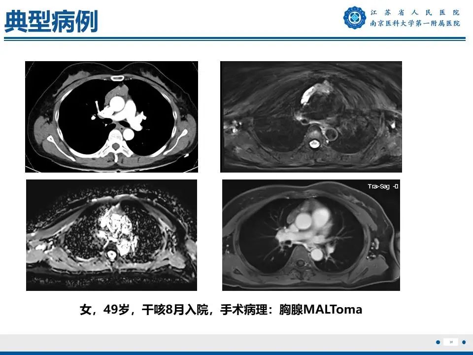 影像PPT - 【PPT】胸腺黏膜相关组织淋巴瘤-32