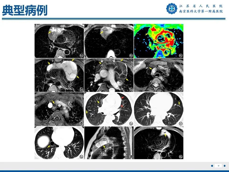 影像PPT - 【PPT】胸腺黏膜相关组织淋巴瘤-33