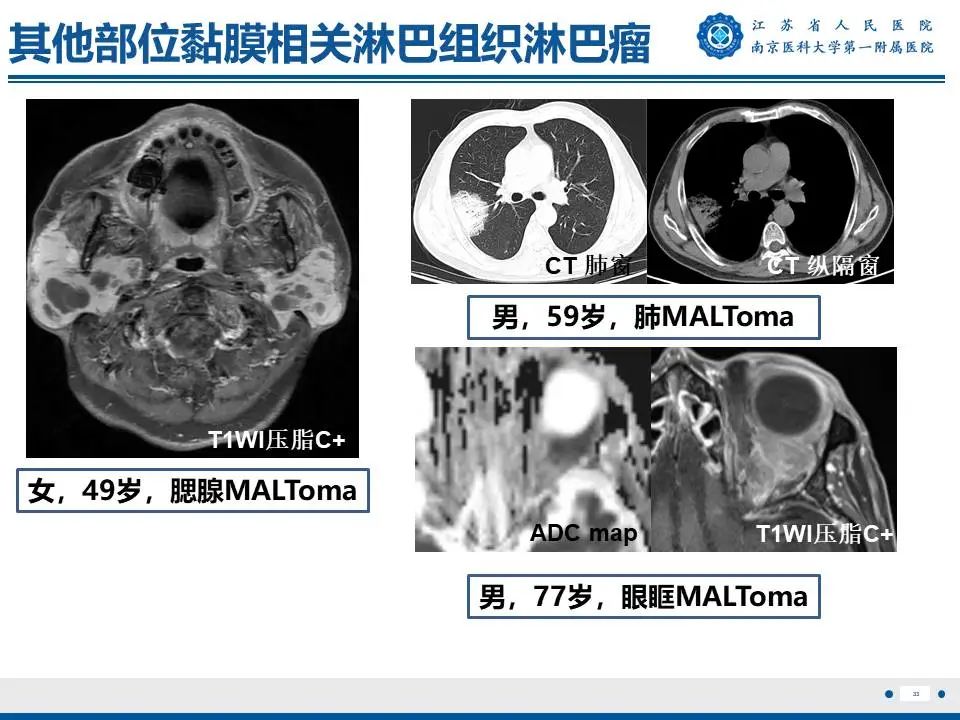 影像PPT - 【PPT】胸腺黏膜相关组织淋巴瘤-34