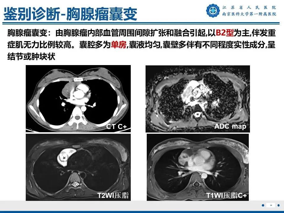 影像PPT - 【PPT】胸腺黏膜相关组织淋巴瘤-35