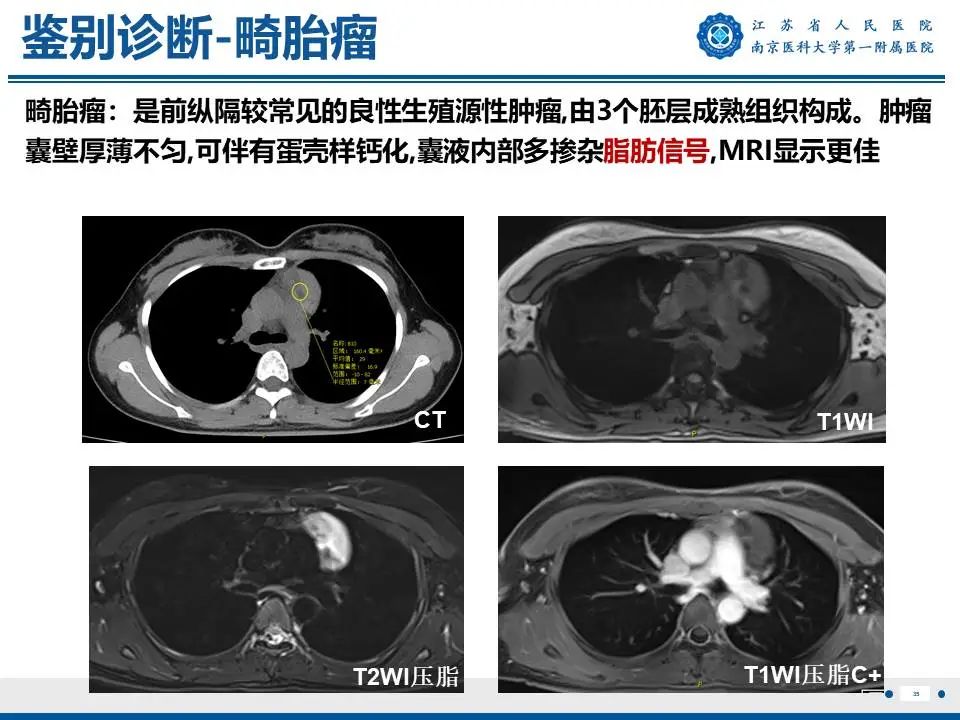 影像PPT - 【PPT】胸腺黏膜相关组织淋巴瘤-36