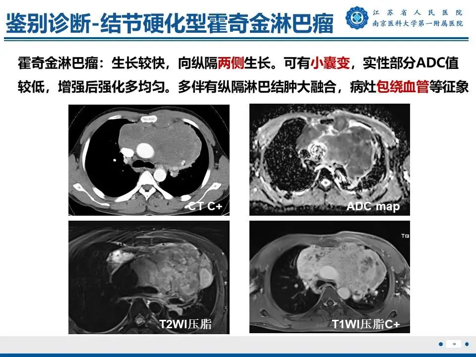 影像PPT - 【PPT】胸腺黏膜相关组织淋巴瘤-37