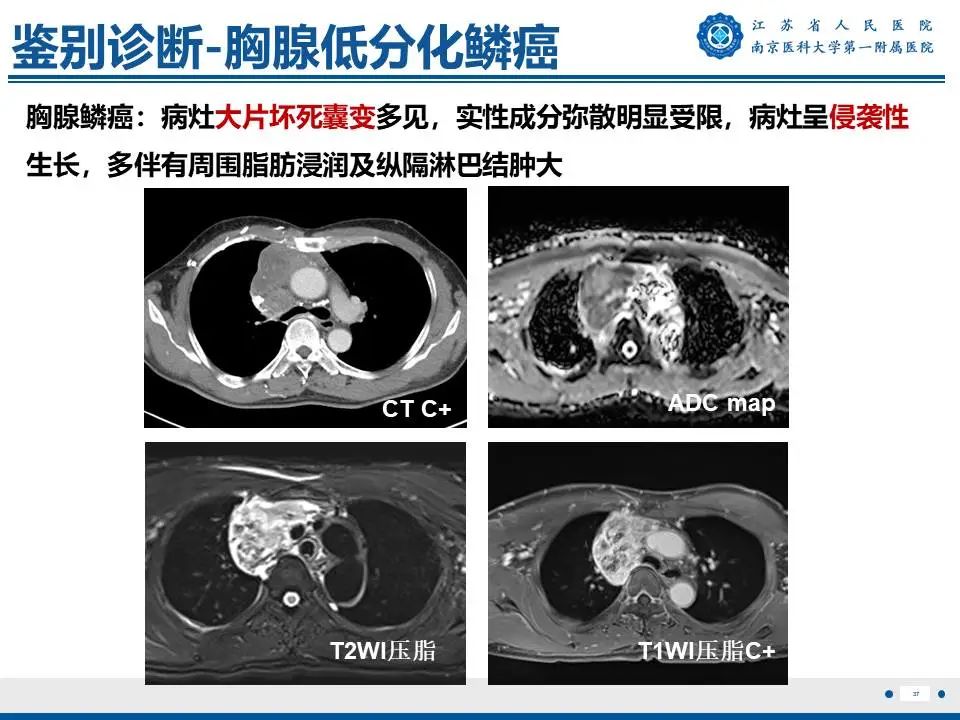影像PPT - 【PPT】胸腺黏膜相关组织淋巴瘤-38
