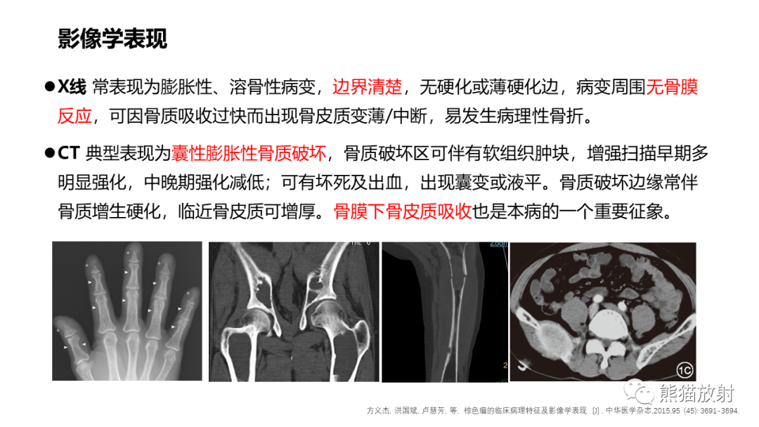 影像PPT - 【病例】髂骨棕色瘤 VS 动脉瘤样骨囊肿-24