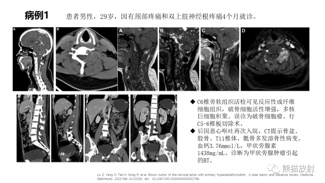影像PPT - 【病例】髂骨棕色瘤 VS 动脉瘤样骨囊肿-26