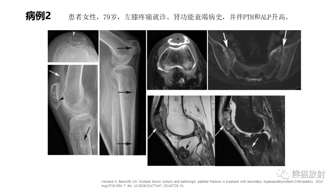 影像PPT - 【病例】髂骨棕色瘤 VS 动脉瘤样骨囊肿-27