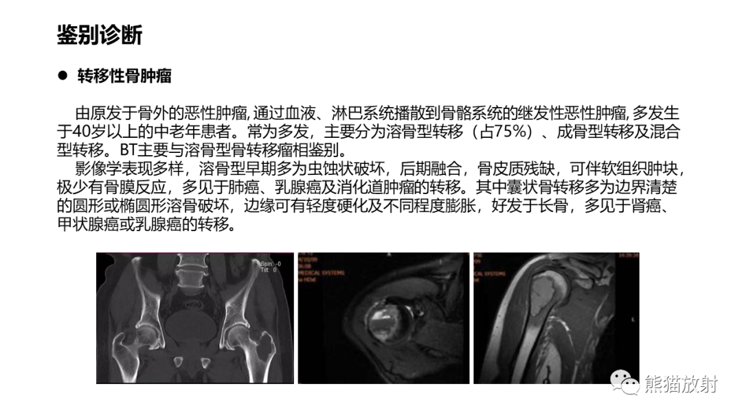 影像PPT - 【病例】髂骨棕色瘤 VS 动脉瘤样骨囊肿-31