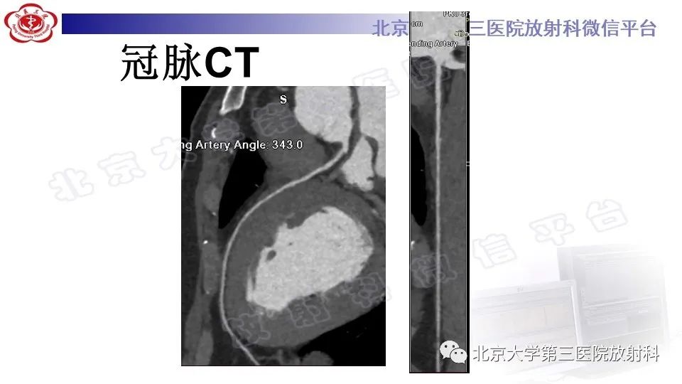 影像PPT - 【PPT】心肌桥-3