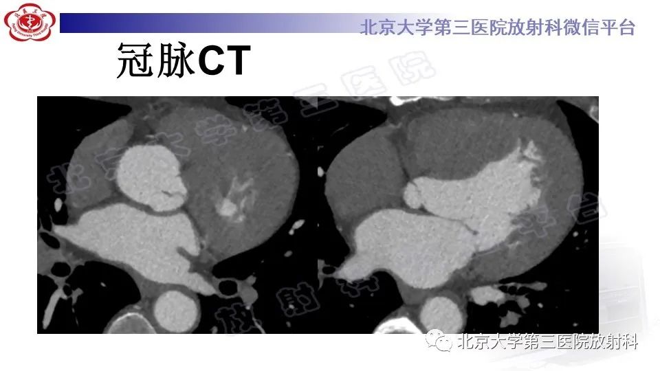 影像PPT - 【PPT】心肌桥-5