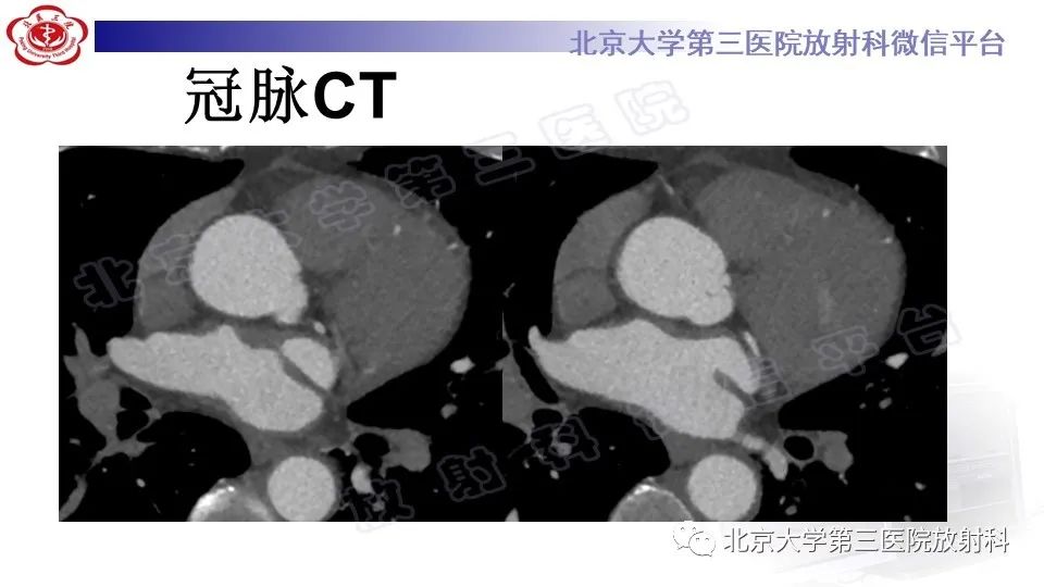 影像PPT - 【PPT】心肌桥-4