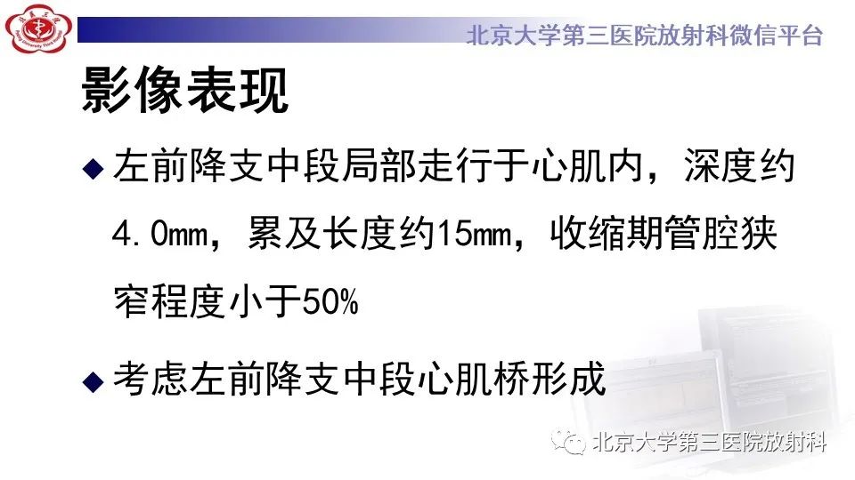 影像PPT - 【PPT】心肌桥-7