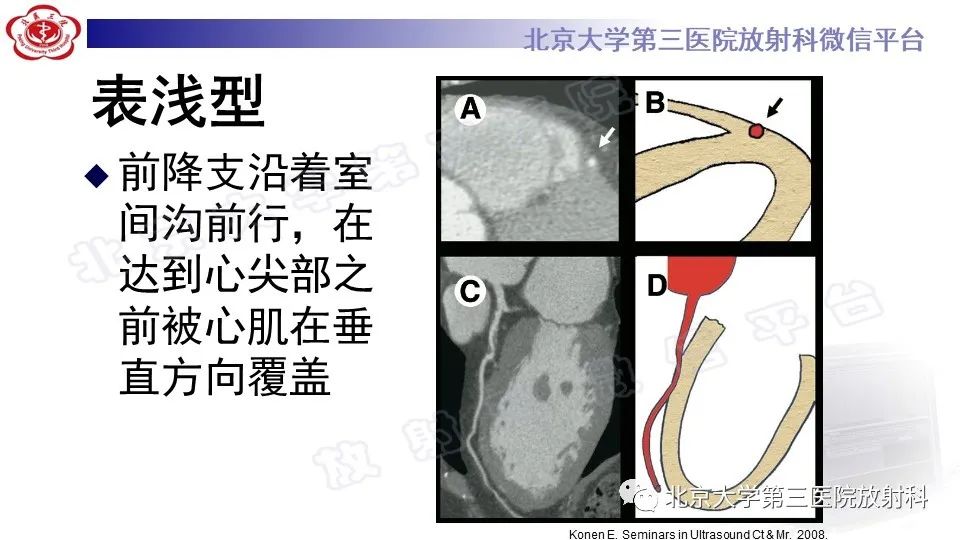 影像PPT - 【PPT】心肌桥-15