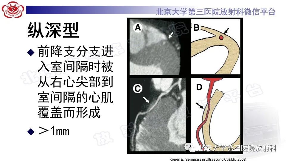 影像PPT - 【PPT】心肌桥-16