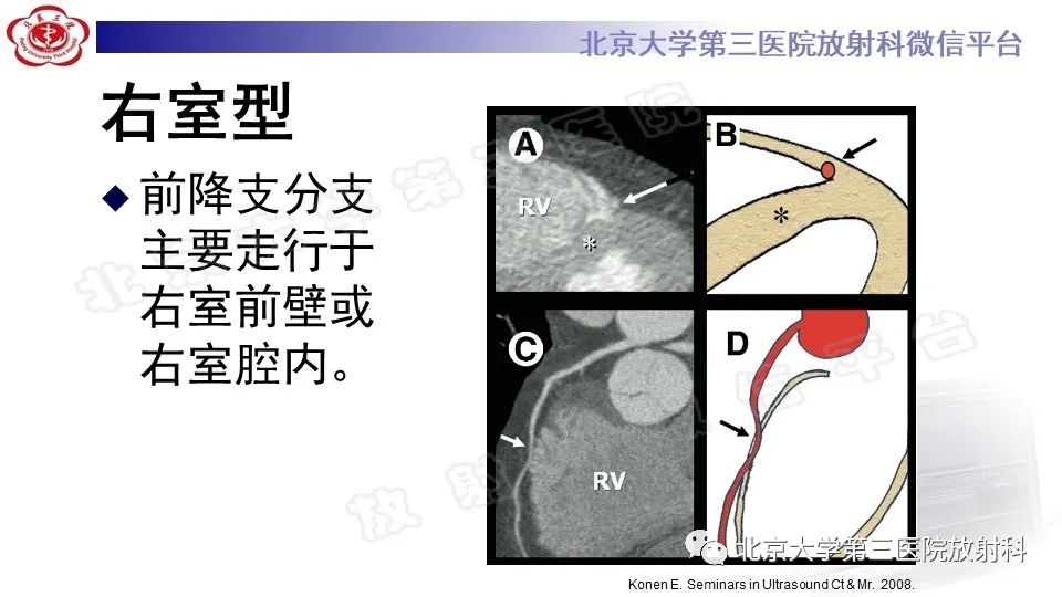 影像PPT - 【PPT】心肌桥-17