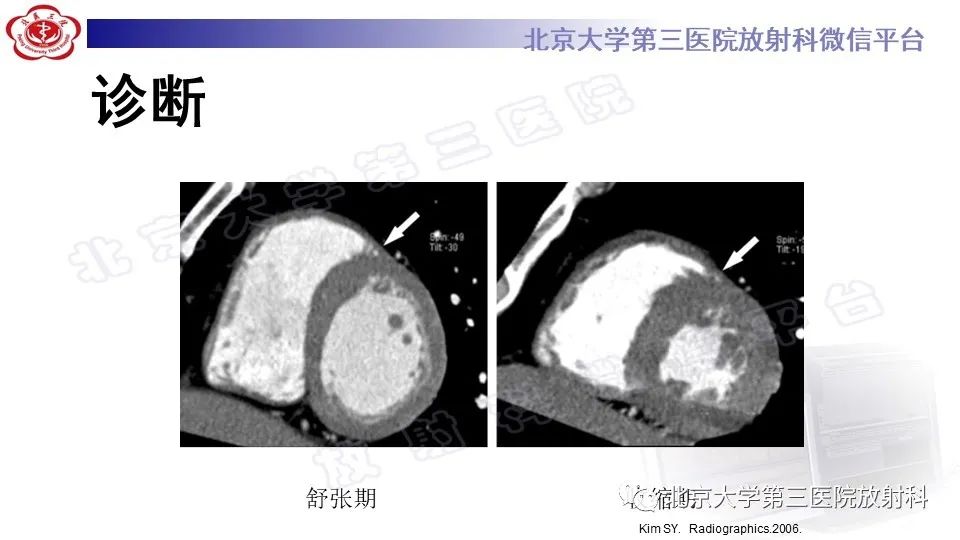 影像PPT - 【PPT】心肌桥-22