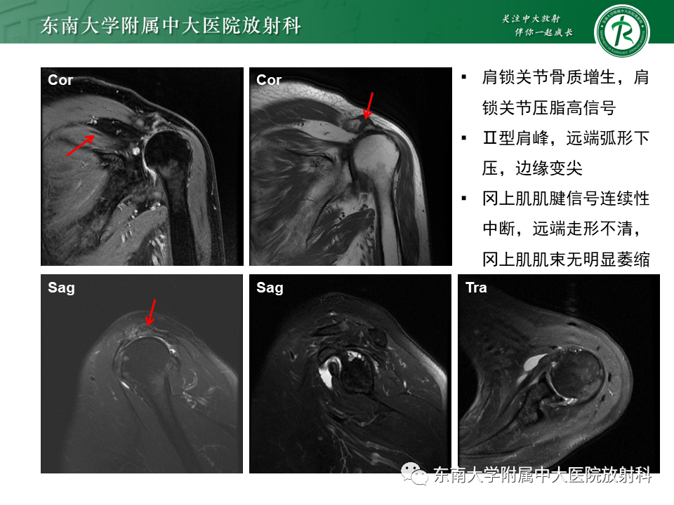 影像PPT - 【PPT】肩峰下撞击综合征-5 影像PPT - 【PPT】肩峰下撞击综合征-5
