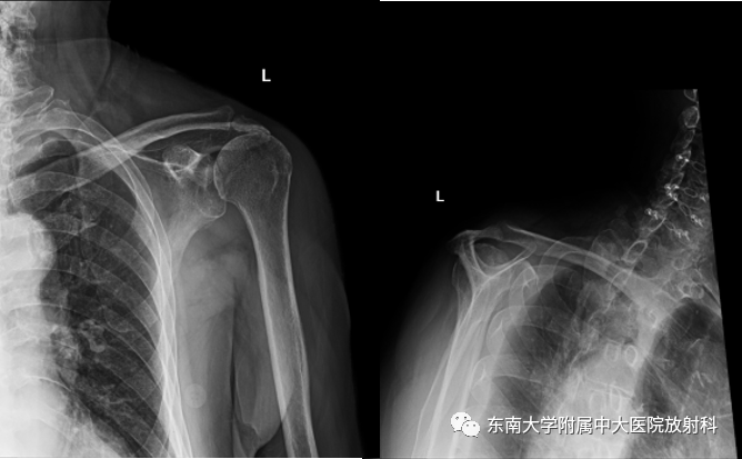 影像PPT - 【PPT】肩峰下撞击综合征-1 影像PPT - 【PPT】肩峰下撞击综合征-1