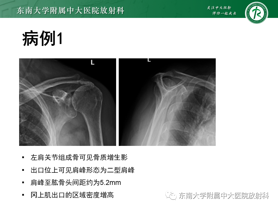 影像PPT - 【PPT】肩峰下撞击综合征-4 影像PPT - 【PPT】肩峰下撞击综合征-4