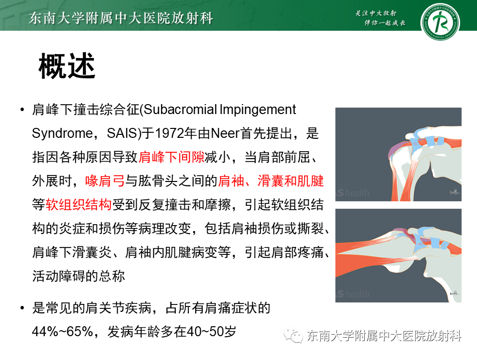 影像PPT - 【PPT】肩峰下撞击综合征-8 影像PPT - 【PPT】肩峰下撞击综合征-8