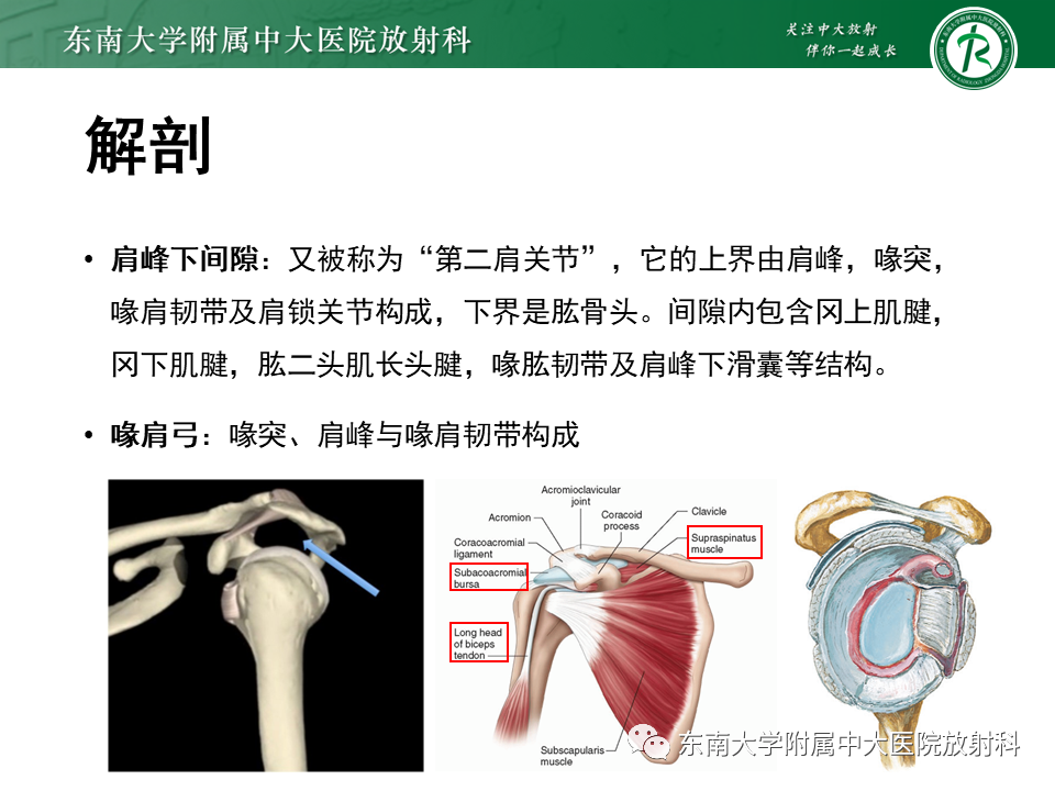 影像PPT - 【PPT】肩峰下撞击综合征-9 影像PPT - 【PPT】肩峰下撞击综合征-9