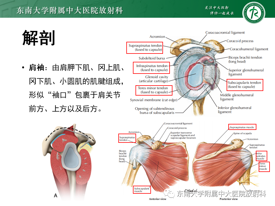 影像PPT - 【PPT】肩峰下撞击综合征-11 影像PPT - 【PPT】肩峰下撞击综合征-11
