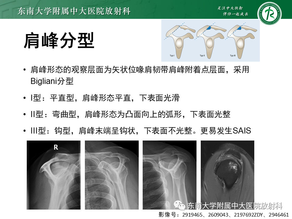 影像PPT - 【PPT】肩峰下撞击综合征-14 影像PPT - 【PPT】肩峰下撞击综合征-14