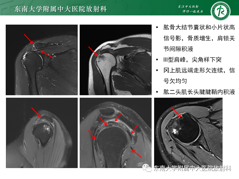 影像PPT - 【PPT】肩峰下撞击综合征-16 影像PPT - 【PPT】肩峰下撞击综合征-16