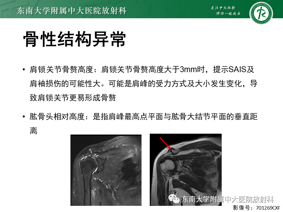 影像PPT - 【PPT】肩峰下撞击综合征-17 影像PPT - 【PPT】肩峰下撞击综合征-17