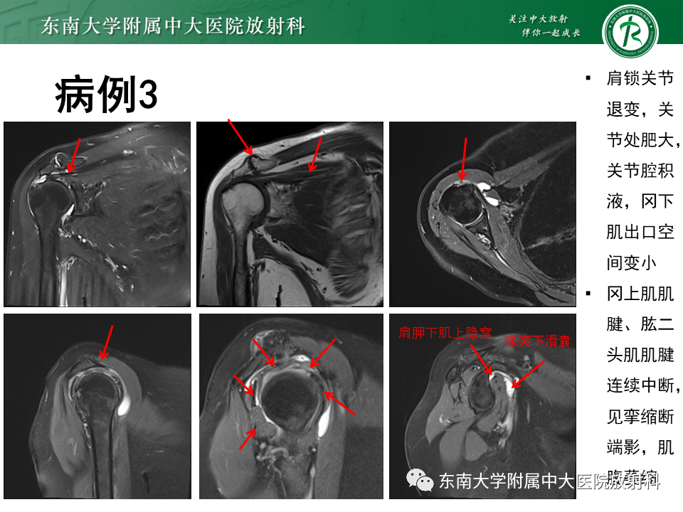 影像PPT - 【PPT】肩峰下撞击综合征-19 影像PPT - 【PPT】肩峰下撞击综合征-19