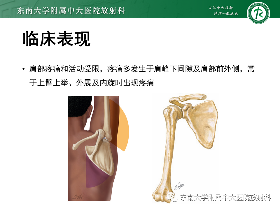 影像PPT - 【PPT】肩峰下撞击综合征-20 影像PPT - 【PPT】肩峰下撞击综合征-20