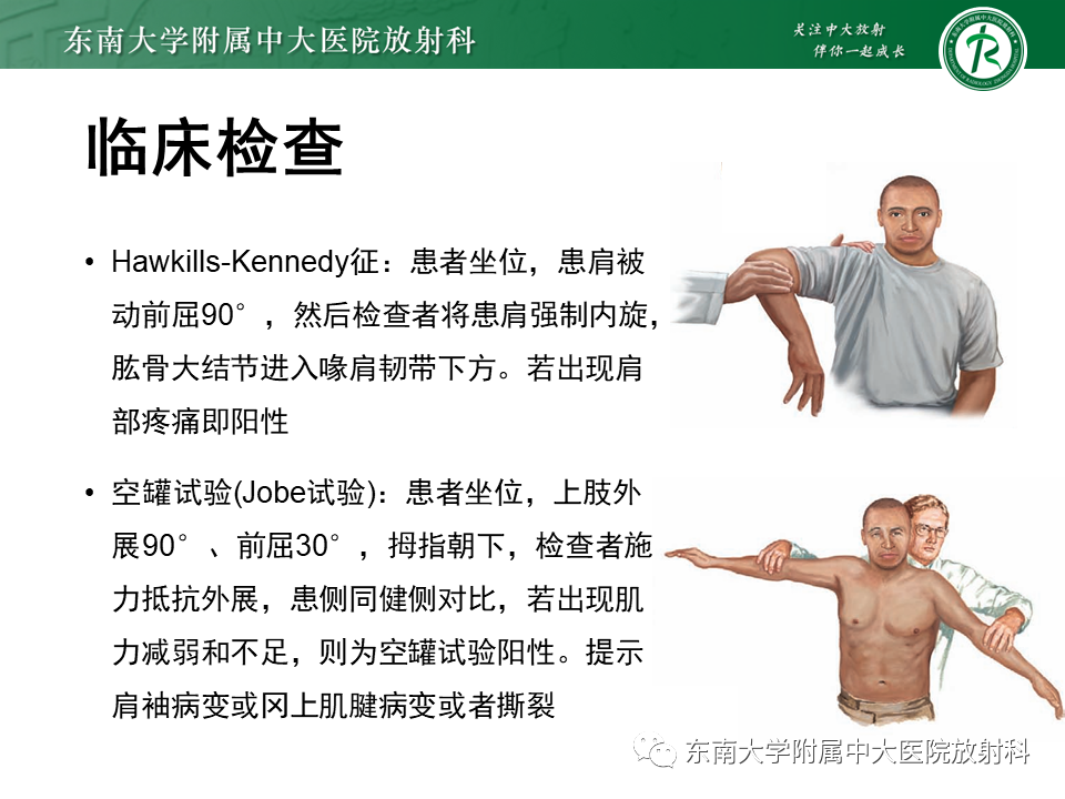 影像PPT - 【PPT】肩峰下撞击综合征-22 影像PPT - 【PPT】肩峰下撞击综合征-22